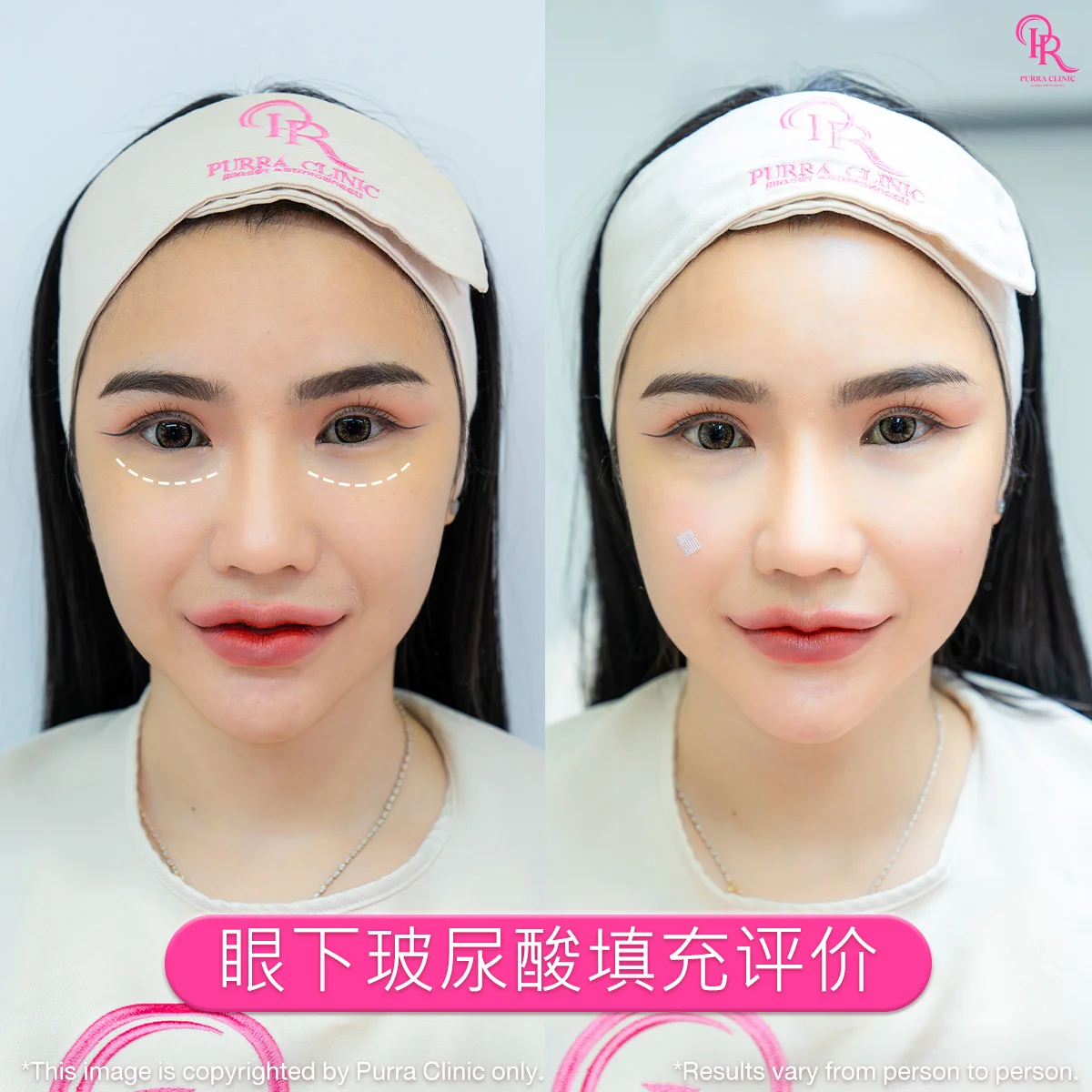 眼下玻尿酸填充评价