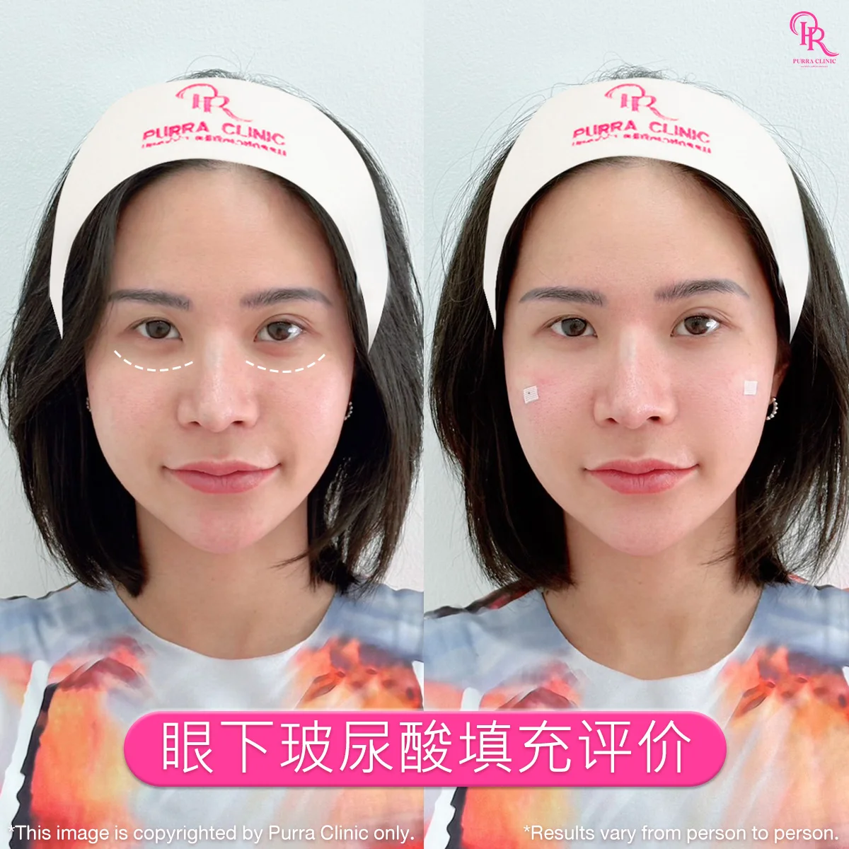 眼下玻尿酸填充评价