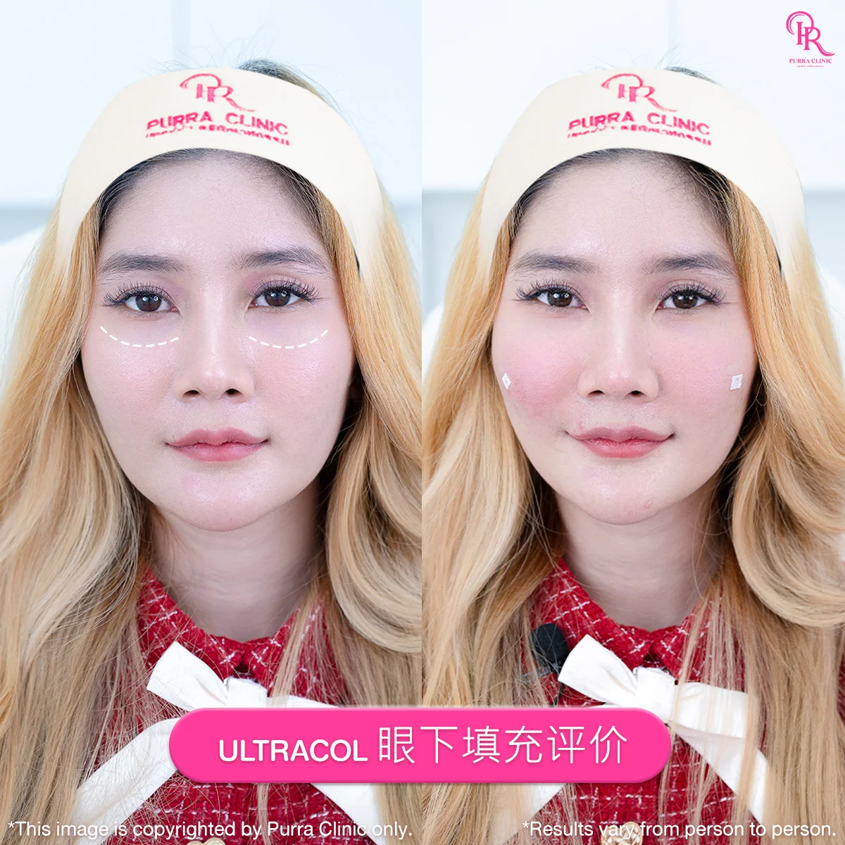 Ultracol眼下填充评价