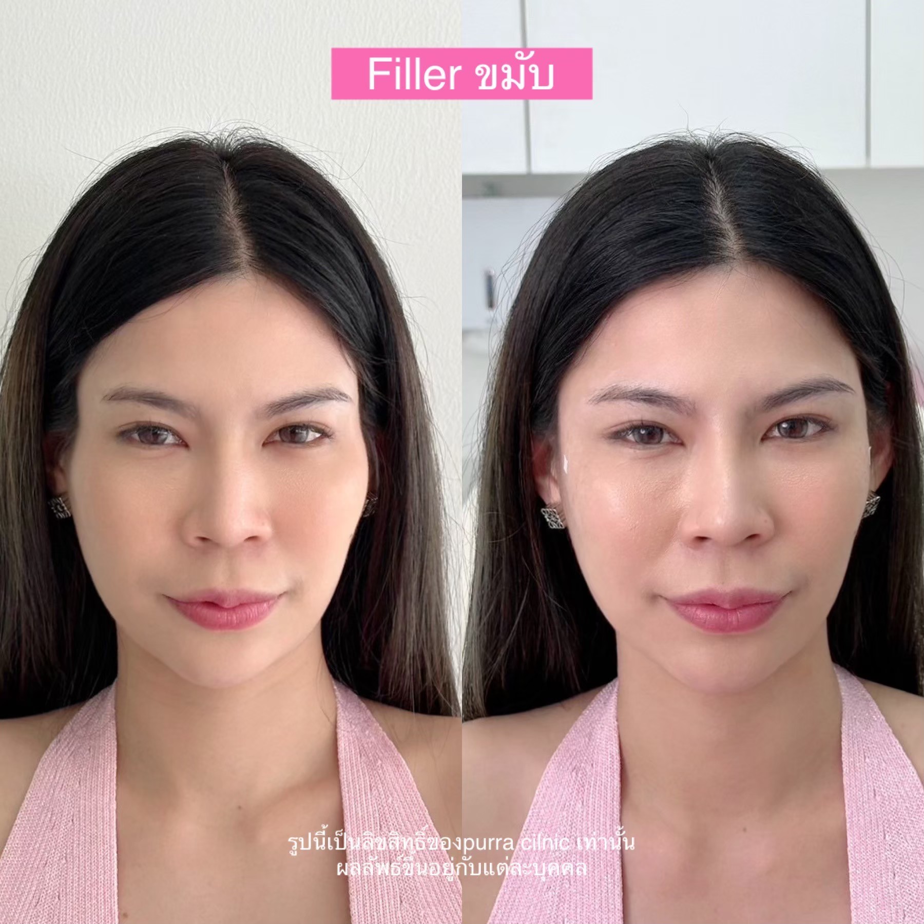 รีวิวฟิลเลอร์ขมับ
