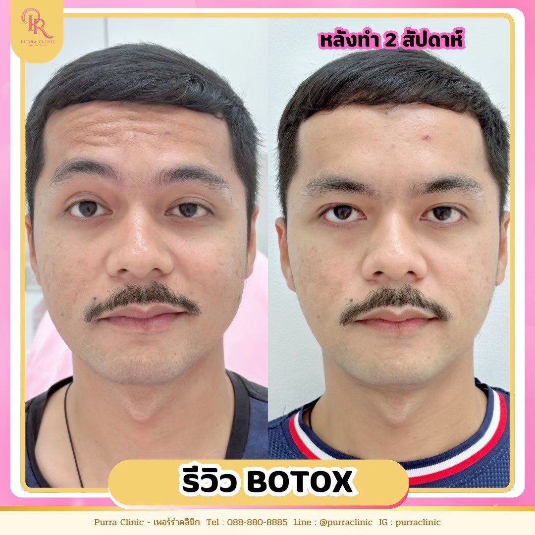 รีวิวโบท็อกซ์ Purra Clinic