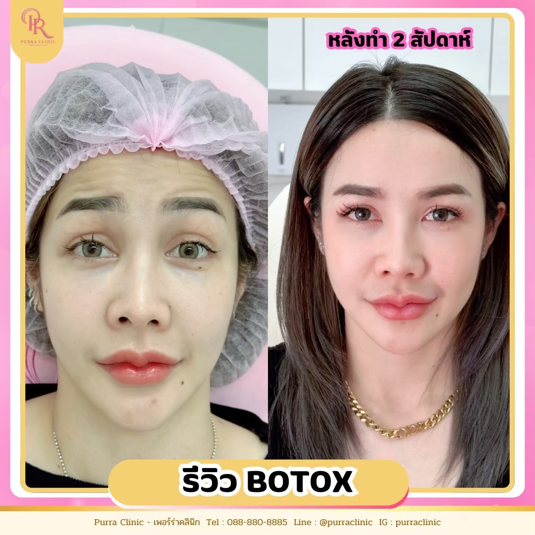 รีวิวโบท็อกซ์ Purra Clinic