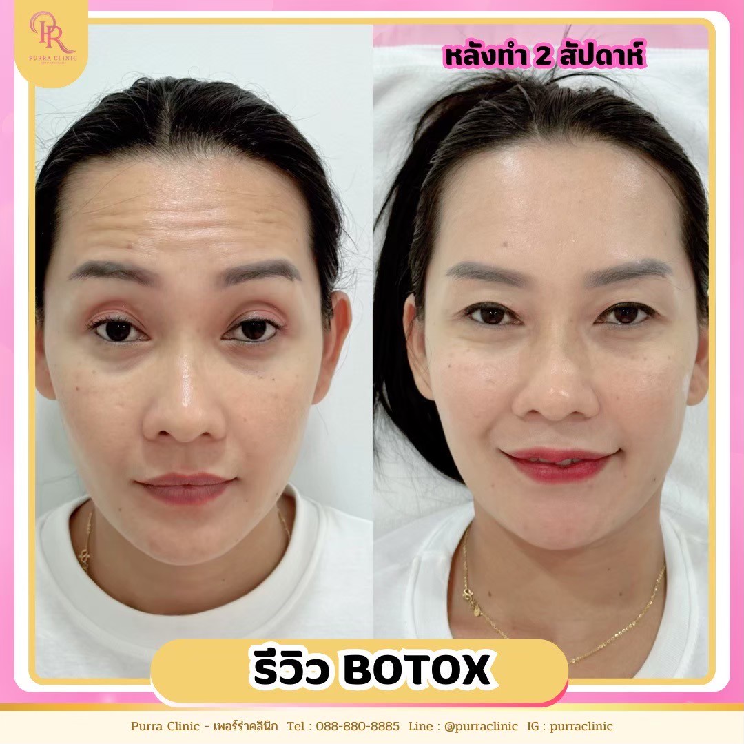 รีวิวโบท็อกซ์ Purra Clinic