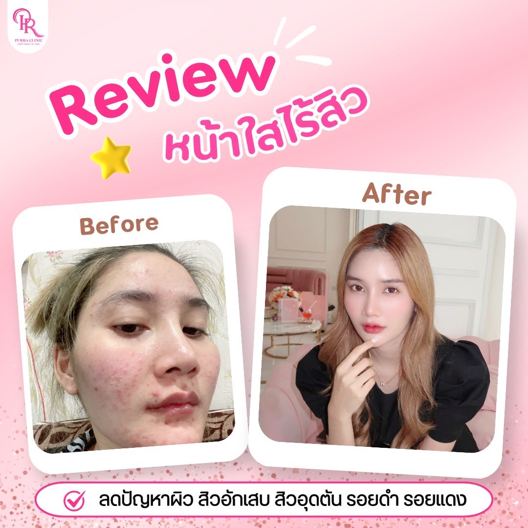 รีวิวหน้าใส