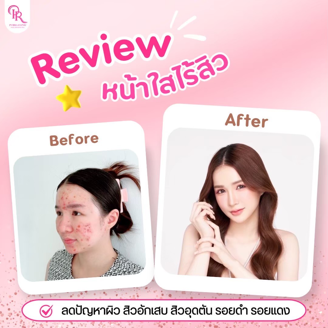 รีวิวหน้าใส