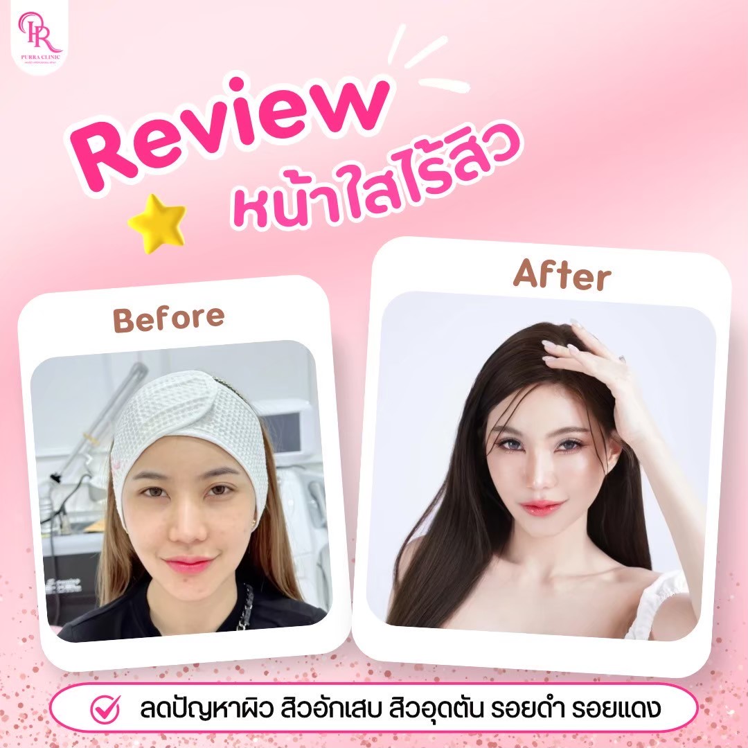 รีวิวหน้าใส
