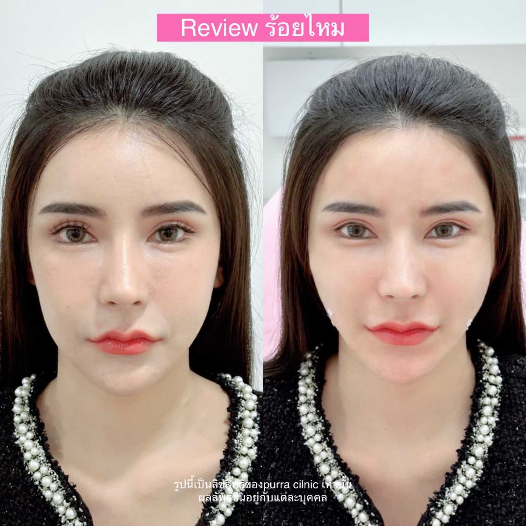 รีวิวร้อยไหม