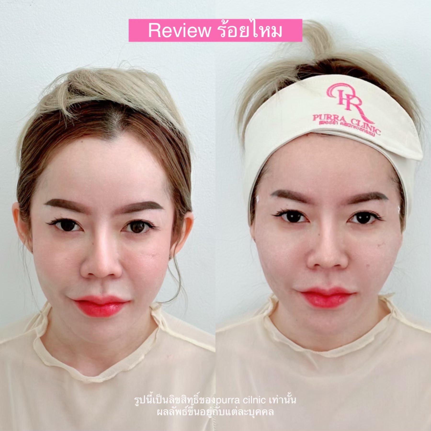 รีวิวร้อยไหม