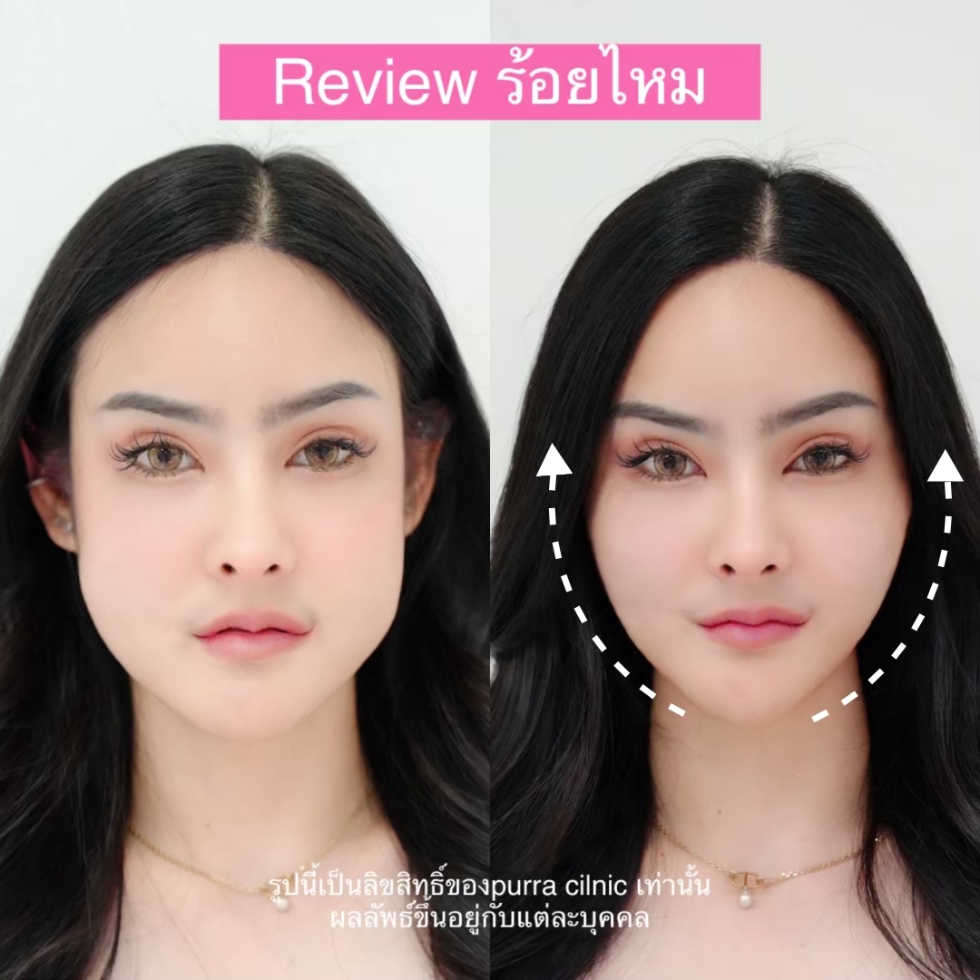 รีวิวร้อยไหม