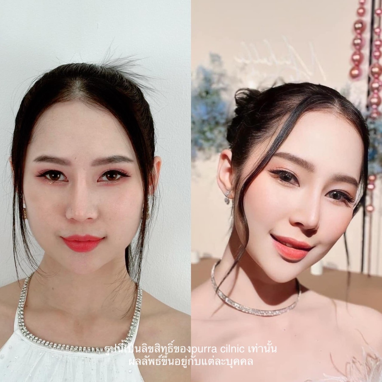 รีวิวแฟต Purra Clinic