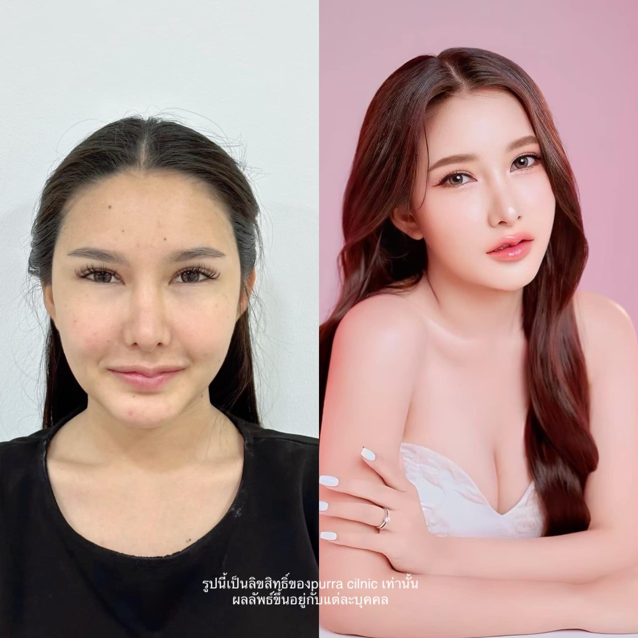 รีวิวแฟต Purra Clinic