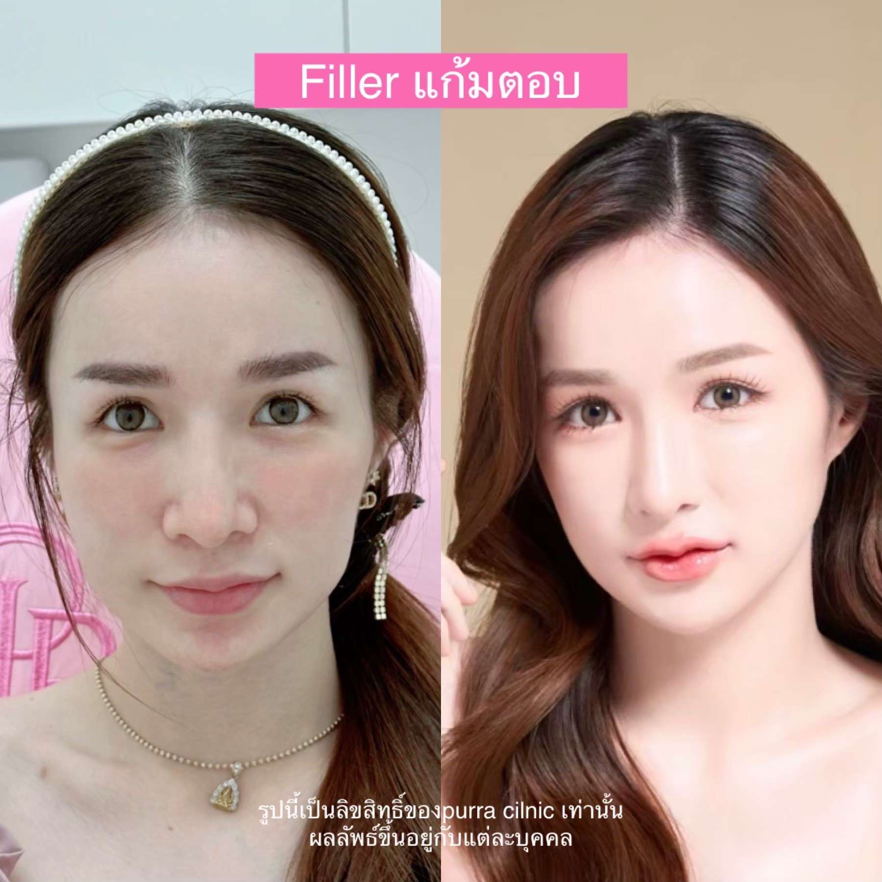 รีวิวฟิลเลอร์แก้ม