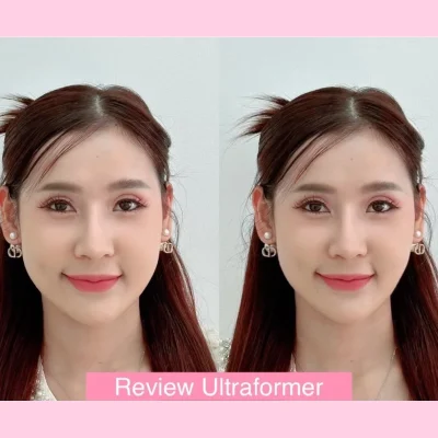 รีวิว Ultraformer